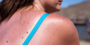 What to Do (and Not Do) When Your Sunburn Starts Peeling
