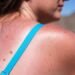 What to Do (and Not Do) When Your Sunburn Starts Peeling