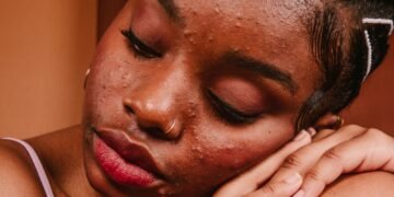 These 9 Acne Myths Just Got Busted By A Dermatologist