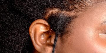 I Got My Scalp Analysed To Help Treat My Natural Hair