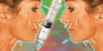 Ist kosmetische Akupunktur besser als Botox?