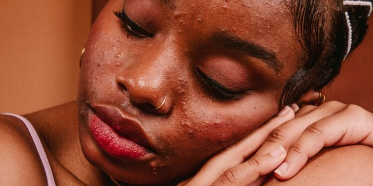 Wie TikTok Menschen mit Akne verunsichert