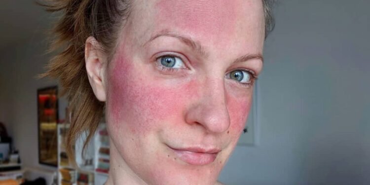 Ich habe Rosacea & mir hilft nur diese Skincare-Routine