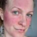 Ich habe Rosacea & mir hilft nur diese Skincare-Routine