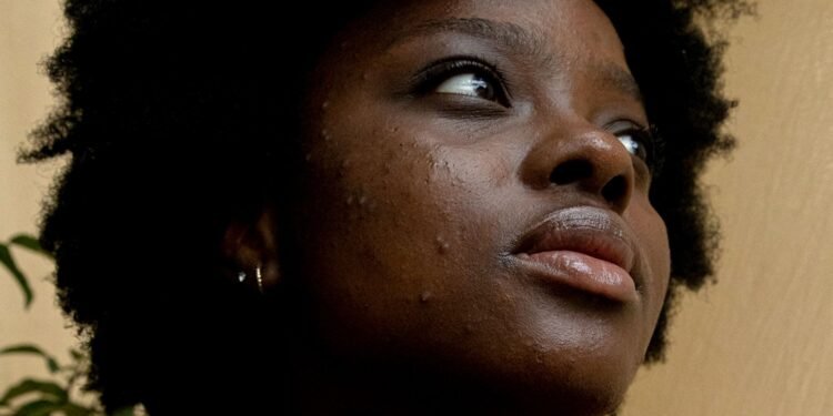 Everyone's Talking About Tretinoin For Great Skin