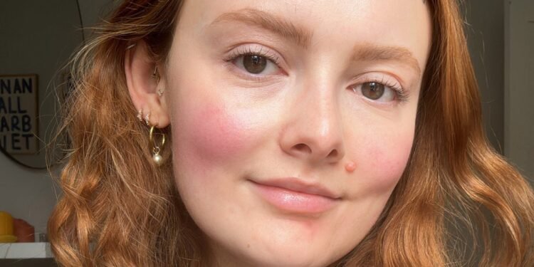 Is My Sex Life Making My Rosacea Worse?