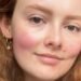 Is My Sex Life Making My Rosacea Worse?